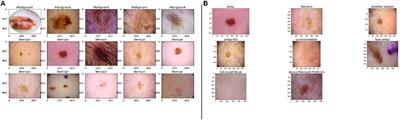 Untangling Classification Methods for Melanoma Skin Cancer